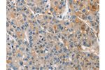 The image on the left is immunohistochemistry of paraffin-embedded Human liver cancer tissue using CSB-PA157353(APOA5 Antibody) at dilution 1/15, on the right is treated with synthetic peptide. (Original magnification: 
