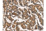 The image on the left is immunohistochemistry of paraffin-embedded Human breast cancer tissue using CSB-PA157358(ARL6IP1 Antibody) at dilution 1/20, on the right is treated with fusion protein. (Original magnification: 