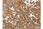 The image on the left is immunohistochemistry of paraffin-embedded Human thyroid cancer tissue using CSB-PA157570(BGN Antibody) at dilution 1/50, on the right is treated with fusion protein. (Original magnification: 