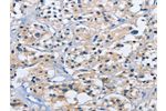 The image on the left is immunohistochemistry of paraffin-embedded Human thyroid cancer tissue using CSB-PA157953(DUSP19 Antibody) at dilution 1/30, on the right is treated with fusion protein. (Original magnification: 