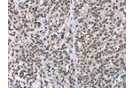 The image on the left is immunohistochemistry of paraffin-embedded Human esophagus cancer tissue using CSB-PA157994(ADNP Antibody) at dilution 1/50, on the right is treated with synthetic peptide. (Original magnification: 
