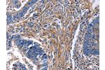The image on the left is immunohistochemistry of paraffin-embedded Human rectal cancer tissue using CSB-PA158258(CXCR5 Antibody) at dilution 1/25, on the right is treated with synthetic peptide. (Original magnification: 