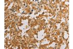 The image on the left is immunohistochemistry of paraffin-embedded Human thyroid cancer tissue using CSB-PA158452(ATG4D Antibody) at dilution 1/40, on the right is treated with fusion protein. (Original magnification: 