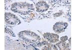 The image on the left is immunohistochemistry of paraffin-embedded Human colon cancer tissue using CSB-PA158538(DOK5 Antibody) at dilution 1/20, on the right is treated with fusion protein. (Original magnification: 