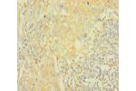 Immunohistochemistry of paraffin-embedded human lung cancer using CSB-PA15919A0Rb at dilution 1:100