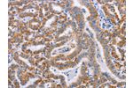 The image on the left is immunohistochemistry of paraffin-embedded Human thyroid cancer tissue using CSB-PA159485(BST1 Antibody) at dilution 1/50, on the right is treated with synthetic peptide. (Original magnification: 