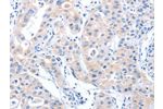 The image on the left is immunohistochemistry of paraffin-embedded Human lung cancer tissue using CSB-PA159616(ARHGEF6 Antibody) at dilution 1/70, on the right is treated with synthetic peptide. (Original magnification: 