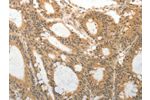 The image on the left is immunohistochemistry of paraffin-embedded Human colon cancer tissue using CSB-PA159695(ADAR Antibody) at dilution 1/25, on the right is treated with synthetic peptide. (Original magnification: 