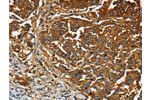 The image on the left is immunohistochemistry of paraffin-embedded Human gastic cancer tissue using CSB-PA160116(CEACAM5 Antibody) at dilution 1/20, on the right is treated with fusion protein. (Original magnification: 