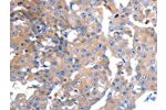 The image on the left is immunohistochemistry of paraffin-embedded Human breast cancer tissue using CSB-PA160122(GCG Antibody) at dilution 1/15, on the right is treated with synthetic peptide. (Original magnification: 