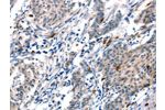 The image on the left is immunohistochemistry of paraffin-embedded Human gastic cancer tissue using CSB-PA160137(ADM Antibody) at dilution 1/20, on the right is treated with synthetic peptide. (Original magnification: 
