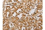 The image on the left is immunohistochemistry of paraffin-embedded Human thyroid cancer tissue using CSB-PA160272(ARHGEF5 Antibody) at dilution 1/40, on the right is treated with fusion protein. (Original magnification: 