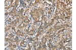 The image on the left is immunohistochemistry of paraffin-embedded Human gastic cancer tissue using CSB-PA160733(CSMD1 Antibody) at dilution 1/40, on the right is treated with synthetic peptide. (Original magnification: 