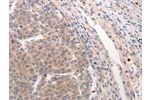 The image on the left is immunohistochemistry of paraffin-embedded Human breast cancer tissue using CSB-PA160889(CDC37 Antibody) at dilution 1/20, on the right is treated with synthetic peptide. (Original magnification: 