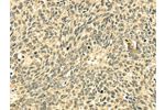 The image on the left is immunohistochemistry of paraffin-embedded Human lung cancer tissue using CSB-PA160915(ECE2 Antibody) at dilution 1/20, on the right is treated with fusion protein. (Original magnification: 