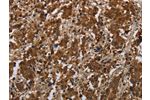 The image on the left is immunohistochemistry of paraffin-embedded Human liver cancer tissue using CSB-PA161181(FGF20 Antibody) at dilution 1/20, on the right is treated with synthetic peptide. (Original magnification: 