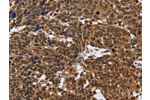 The image on the left is immunohistochemistry of paraffin-embedded Human cervical cancer tissue using CSB-PA161267(EDN2 Antibody) at dilution 1/30, on the right is treated with fusion protein. (Original magnification: 