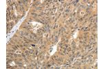 The image on the left is immunohistochemistry of paraffin-embedded Human ovarian cancer tissue using CSB-PA161346(CNNM3 Antibody) at dilution 1/25, on the right is treated with fusion protein. (Original magnification: 