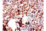 Immunohistochemistry of paraffin-embedded human lung cancer using CSB-PA16139A0Rb at dilution of 1:100