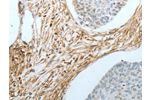 The image on the left is immunohistochemistry of paraffin-embedded Human cervical cancer tissue using CSB-PA161781(CRMP1 Antibody) at dilution 1/20, on the right is treated with fusion protein. (Original magnification: 