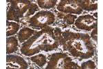 The image on the left is immunohistochemistry of paraffin-embedded Human colon cancer tissue using CSB-PA162395(CERS5 Antibody) at dilution 1/35, on the right is treated with synthetic peptide. (Original magnification: 