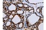 The image on the left is immunohistochemistry of paraffin-embedded Human thyroid cancer tissue using CSB-PA162597(EGFR Antibody) at dilution 1/15, on the right is treated with synthetic peptide. (Original magnification: 