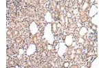 The image on the left is immunohistochemistry of paraffin-embedded Human thyroid cancer tissue using CSB-PA162953(CDK8 Antibody) at dilution 1/20, on the right is treated with synthetic peptide. (Original magnification: 