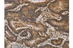 The image on the left is immunohistochemistry of paraffin-embedded Human thyroid cancer tissue using CSB-PA163077(CCL26 Antibody) at dilution 1/20, on the right is treated with synthetic peptide. (Original magnification: 