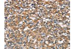 The image on the left is immunohistochemistry of paraffin-embedded Human thyroid cancer tissue using CSB-PA163318(APOA1BP Antibody) at dilution 1/15, on the right is treated with synthetic peptide. (Original magnification: 