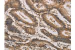 The image on the left is immunohistochemistry of paraffin-embedded Human colon cancer tissue using CSB-PA163406(CLEC5A Antibody) at dilution 1/20, on the right is treated with synthetic peptide. (Original magnification: 