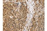 The image on the left is immunohistochemistry of paraffin-embedded Human cervical cancer tissue using CSB-PA163656(BRAF Antibody) at dilution 1/30, on the right is treated with synthetic peptide. (Original magnification: 