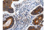 The image on the left is immunohistochemistry of paraffin-embedded Human colon cancer tissue using CSB-PA164023(CDH1 Antibody) at dilution 1/100, on the right is treated with synthetic peptide. (Original magnification: 