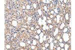 The image on the left is immunohistochemistry of paraffin-embedded Human thyroid cancer tissue using CSB-PA164672(CMKLR1 Antibody) at dilution 1/35, on the right is treated with synthetic peptide. (Original magnification: 