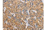 The image on the left is immunohistochemistry of paraffin-embedded Human liver cancer tissue using CSB-PA165028(APLNR Antibody) at dilution 1/40, on the right is treated with fusion protein. (Original magnification: 