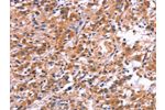 The image on the left is immunohistochemistry of paraffin-embedded Human thyroid cancer tissue using CSB-PA165039(APMAP Antibody) at dilution 1/30, on the right is treated with synthetic peptide. (Original magnification: 