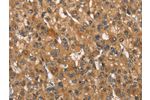 The image on the left is immunohistochemistry of paraffin-embedded Human liver cancer tissue using CSB-PA165586(APOA1BP Antibody) at dilution 1/30, on the right is treated with synthetic peptide. (Original magnification: 