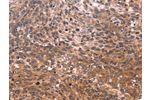 The image on the left is immunohistochemistry of paraffin-embedded Human cervical cancer tissue using CSB-PA165659(GCG Antibody) at dilution 1/20, on the right is treated with synthetic peptide. (Original magnification: 