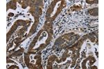 The image on the left is immunohistochemistry of paraffin-embedded Human gastic cancer tissue using CSB-PA167353(BRINP1 Antibody) at dilution 1/20, on the right is treated with fusion protein. (Original magnification: 