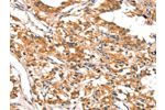 The image on the left is immunohistochemistry of paraffin-embedded Human thyroid cancer tissue using CSB-PA167820(DAB2IP Antibody) at dilution 1/20, on the right is treated with synthetic peptide. (Original magnification: 