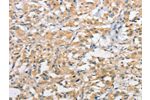 The image on the left is immunohistochemistry of paraffin-embedded Human thyroid cancer tissue using CSB-PA167980(ATG10 Antibody) at dilution 1/60, on the right is treated with fusion protein. (Original magnification: 