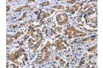 The image on the left is immunohistochemistry of paraffin-embedded Human breast cancer tissue using CSB-PA168224(CRABP2 Antibody) at dilution 1/20, on the right is treated with fusion protein. (Original magnification: 