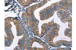 The image on the left is immunohistochemistry of paraffin-embedded Human cervical cancer tissue using CSB-PA168757(EDN2 Antibody) at dilution 1/50, on the right is treated with fusion protein. (Original magnification: 
