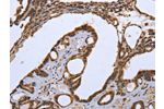 The image on the left is immunohistochemistry of paraffin-embedded Human thyroid cancer tissue using CSB-PA168936(CXCR3  Antibody) at dilution 1/20, on the right is treated with synthetic peptide. (Original magnification: 
