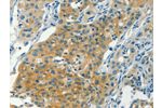 The image on the left is immunohistochemistry of paraffin-embedded Human liver cancer tissue using CSB-PA168970(CHRNA2 Antibody) at dilution 1/30, on the right is treated with synthetic peptide. (Original magnification: 