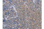 The image on the left is immunohistochemistry of paraffin-embedded Human Lymphoma tissue using CSB-PA169235(CCL16  Antibody) at dilution 1/50, on the right is treated with synthetic peptide. (Original magnification: 