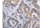 The image on the left is immunohistochemistry of paraffin-embedded Human gastic cancer tissue using CSB-PA169274(AGPS Antibody) at dilution 1/25, on the right is treated with fusion protein. (Original magnification: 