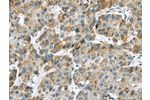 The image on the left is immunohistochemistry of paraffin-embedded Human liver cancer tissue using CSB-PA169699(CHRNA1 Antibody) at dilution 1/20, on the right is treated with synthetic peptide. (Original magnification: 