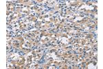 The image on the left is immunohistochemistry of paraffin-embedded Human thyroid cancer tissue using CSB-PA169739(CDC25B  Antibody) at dilution 1/50, on the right is treated with synthetic peptide. (Original magnification: 