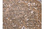 The image on the left is immunohistochemistry of paraffin-embedded Human cervical cancer tissue using CSB-PA170130(ERCC6L Antibody) at dilution 1/30, on the right is treated with fusion protein. (Original magnification: 