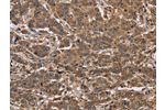 The image on the left is immunohistochemistry of paraffin-embedded Human liver cancer tissue using CSB-PA170264(FABP6 Antibody) at dilution 1/30, on the right is treated with fusion protein. (Original magnification: 